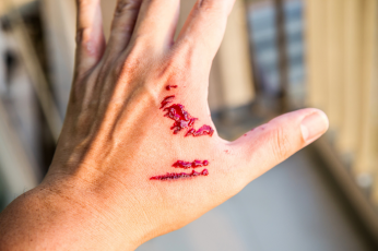 Hand with a deep scratch wound - Mercer Legal Group services