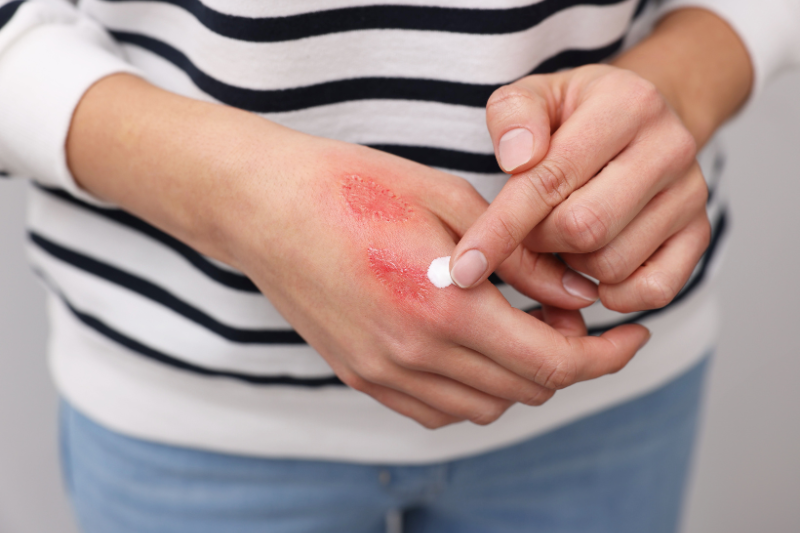 Person holding a swollen wrist - Mercer Legal Group services