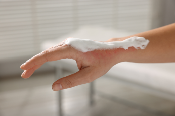 Close-up of a burned hand being treated - Mercer Legal Group services